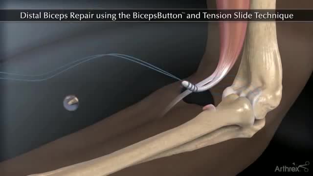 ⁣Arthrex Distal Biceps Button Tension Slide Technique