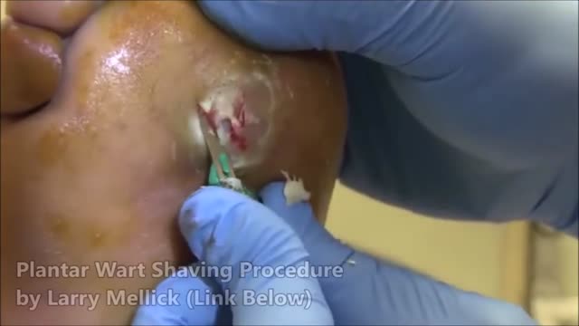 ⁣Worst Plantar Warts & Plantar Wart Removal