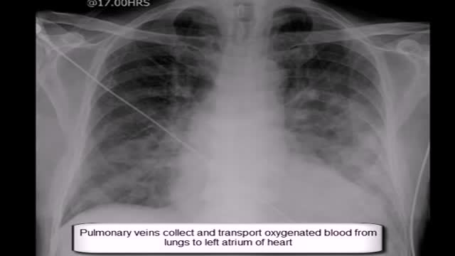 ⁣Pulmonary edema, lungs