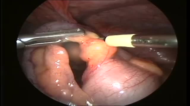 ⁣Appendix Operation
