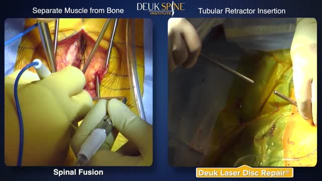 ⁣Laser Disc Repair vs Traditional Spinal Fusion Comparison