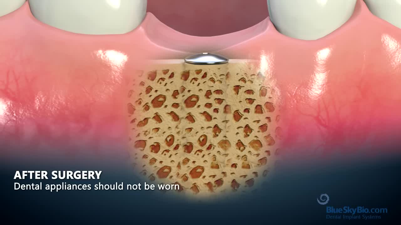 ⁣How do dental implants work?