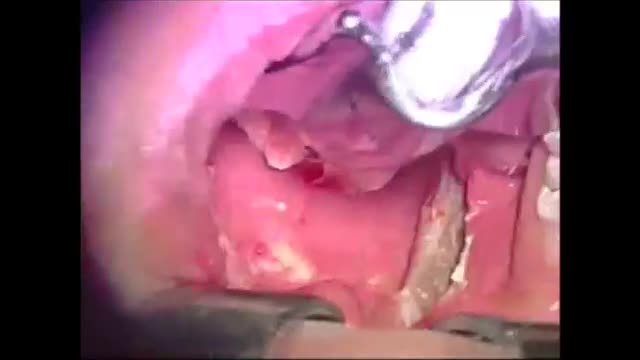 ⁣bipolar microscopic tonsillectomy