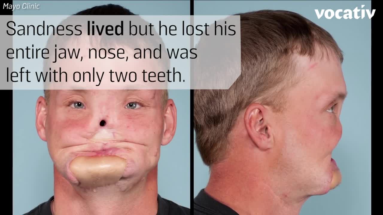 3D-Printing Helped This Man Get A New Face