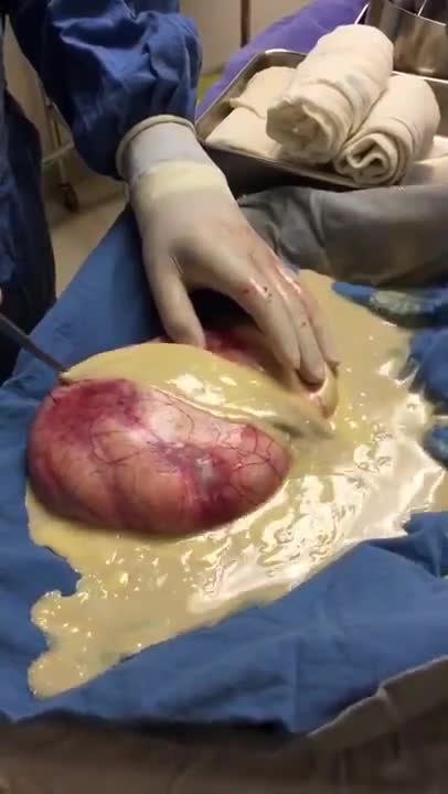 Ovarian Teratoma