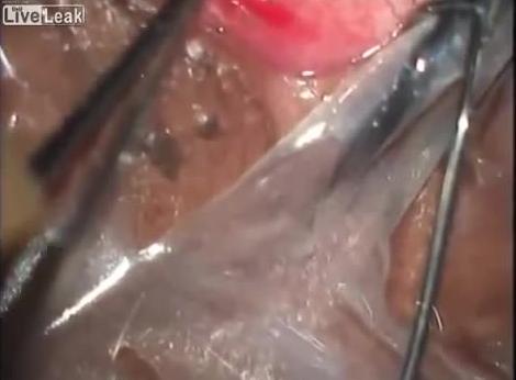 ⁣Removing a 20-CM Long Loa Loa Worm from the Eye