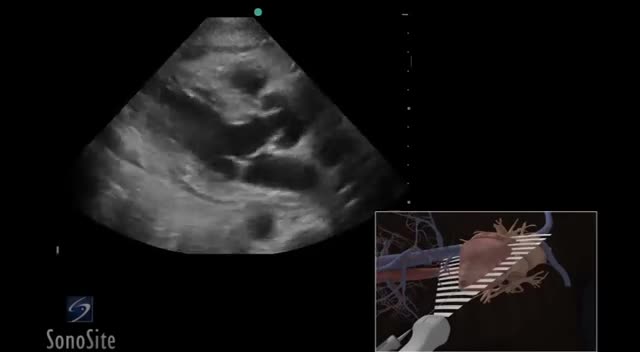 ⁣3D How To: Ultrasound Guided Paricardiocentesis Procedure - SonoSite Ultrasound