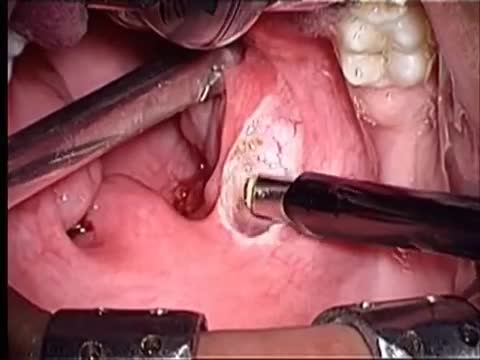 ⁣Adult tonsillectomy