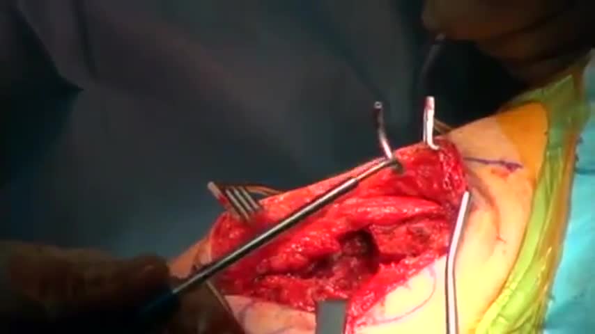 Shoulder Separation Surgery