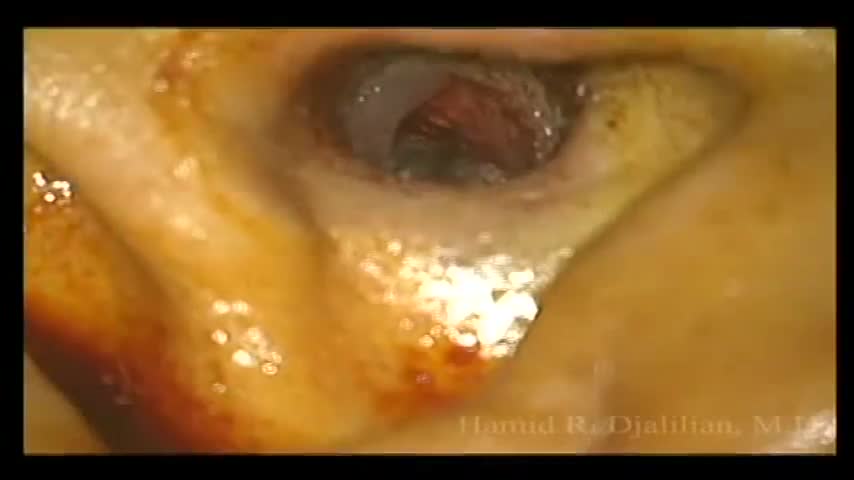 Surfer ear surgery (exostoses removal)
