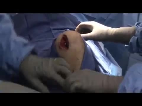 What is a Makoplasty Partial Knee Replacement?