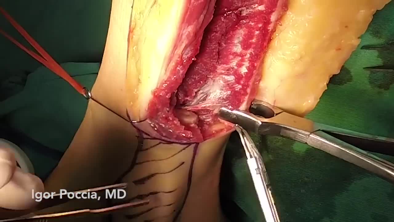 ⁣Fibula flap harvest from the posterior approach