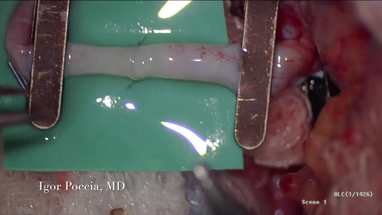 ⁣End To End Arterial Arterial Anastomosis