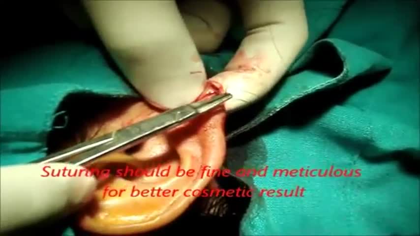 Ear Lobe Repair