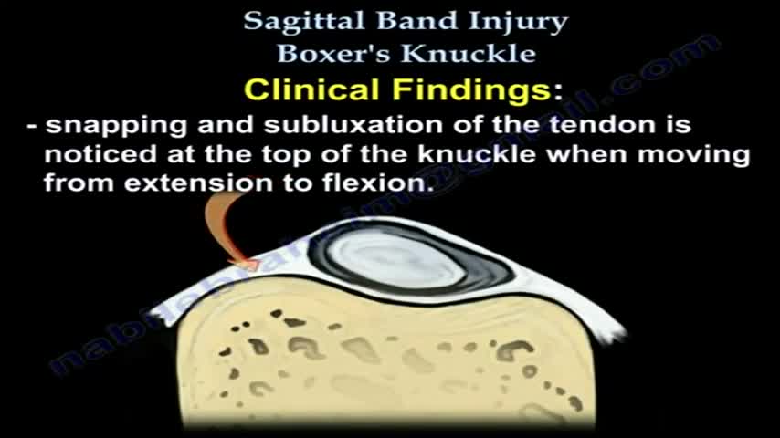 Boxer's Knuckle