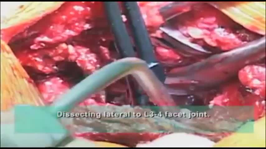 ⁣Dissection of the Transverse Process