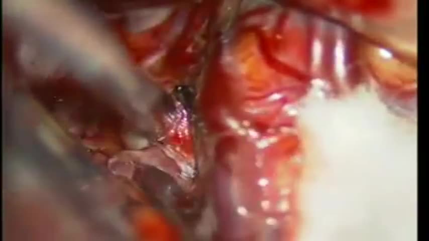 ⁣Middle cerebral artery aneurysm