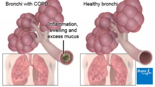 ⁣How chronic obstructive pulmonary disease  develops