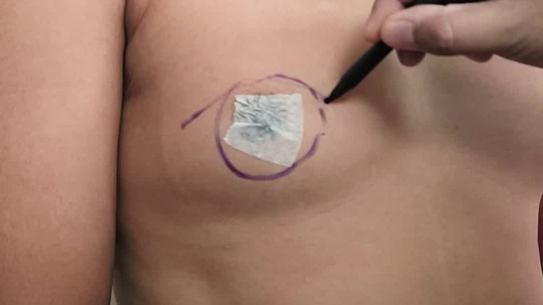 ⁣How is Gynecomastia Surgery Performed?