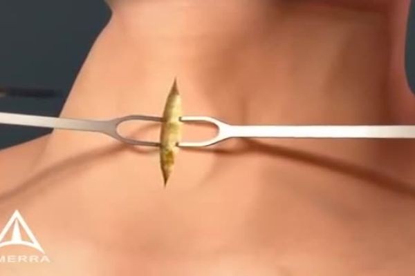 What Is a Tracheotomy? Why It Is Done and How It Works