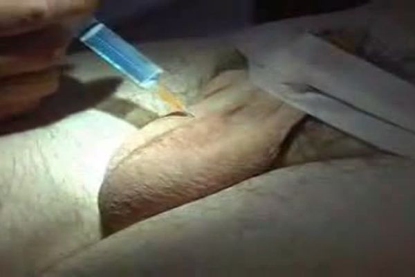 What Is a Vasectomy?