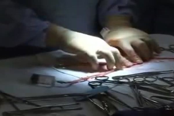 What Is Coronary Bypass Surgery (CABG)?