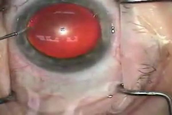 What Is a Cataract and How Is It Removed?