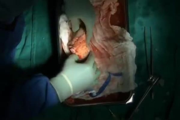 What Is a Kidney Transplant?