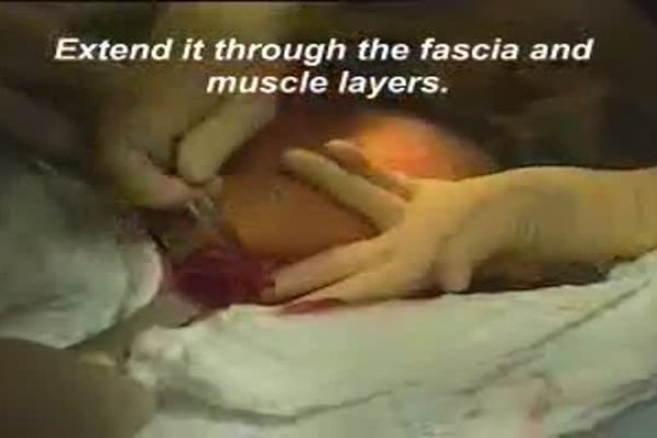 Cesarean vs Vaginal Delivery: How They Differ