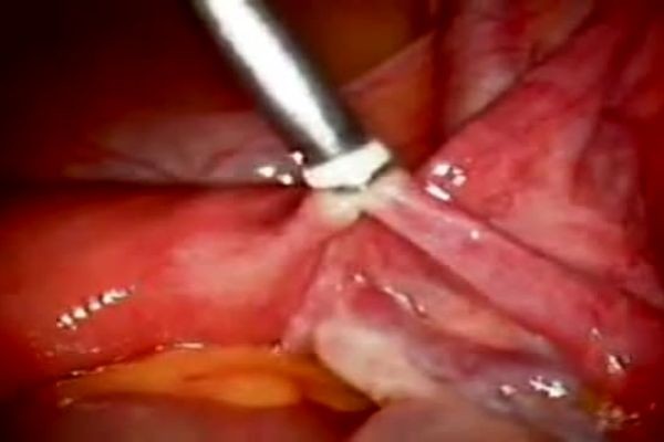 What Is Tubal Ligation?