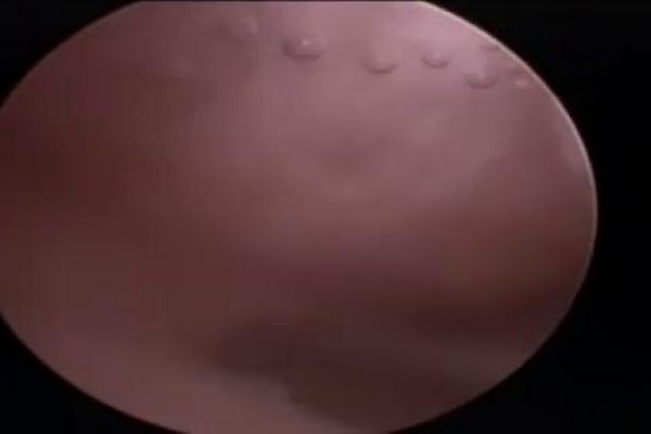 What Is a Rotator Cuff Tear and How Is It Repaired?